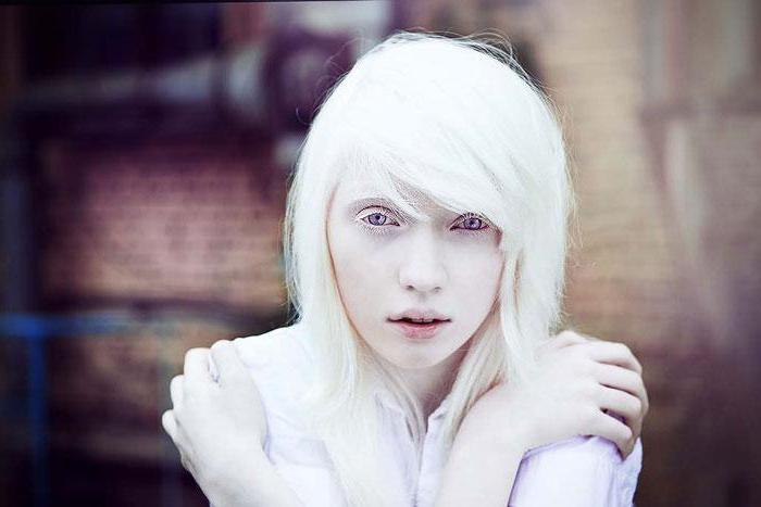 Albinism: Causes, Symptoms, Diagnosis and Treatment
