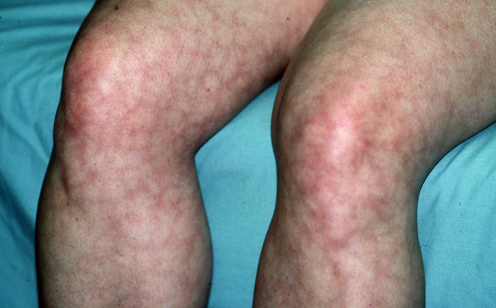 Livedo Reticularis Skin Disorders