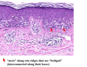 The Clark Melanocytic Nevus (Dysplastic Melanocytic Nevus, Atypical ...