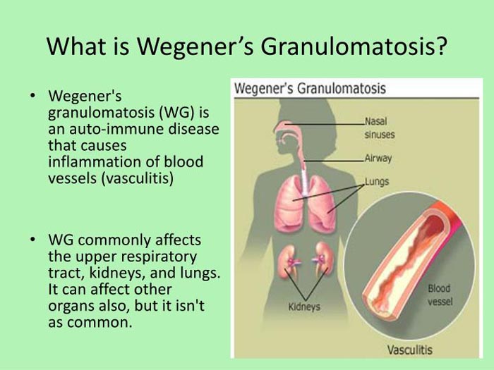 Wegener's Granulomatosis: Causes, Symptoms and Treatment