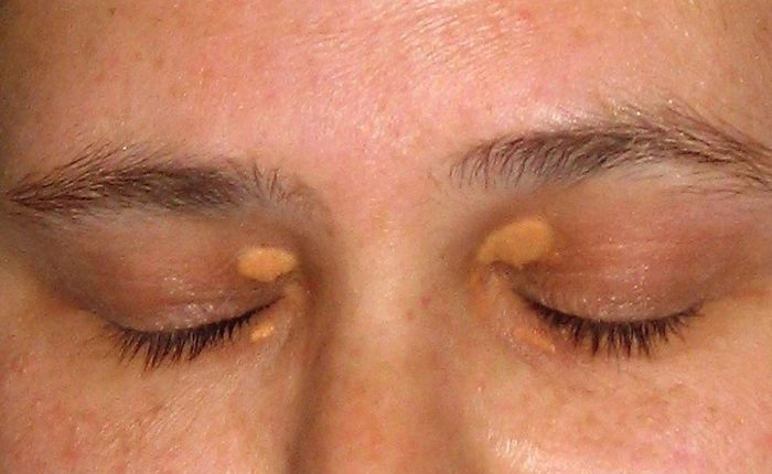 Xanthelasma Causes Symptoms And Treatment