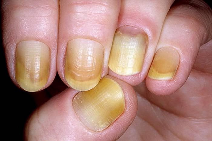 Yellow Nail Syndrome Causes Symptoms And Treatment