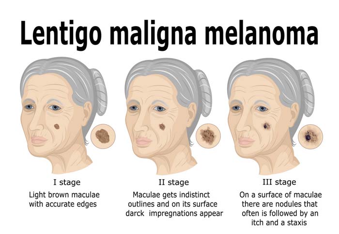 Lentigo Maligna And Lentigo Maligna Melanoma Causes Symptoms And