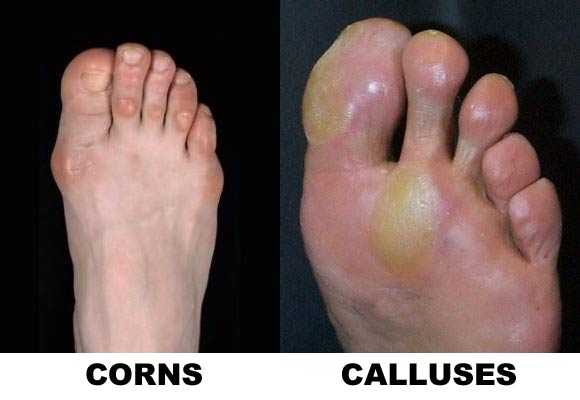 Corns And Calluses Treatment And Home Remedies